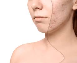 What are the Available Acne Treatments in Singapore?