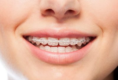 Do Braces Hurt? What to Expect at Each Stage of the Treatment