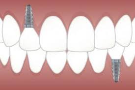 Preparation Process for Dental Implants