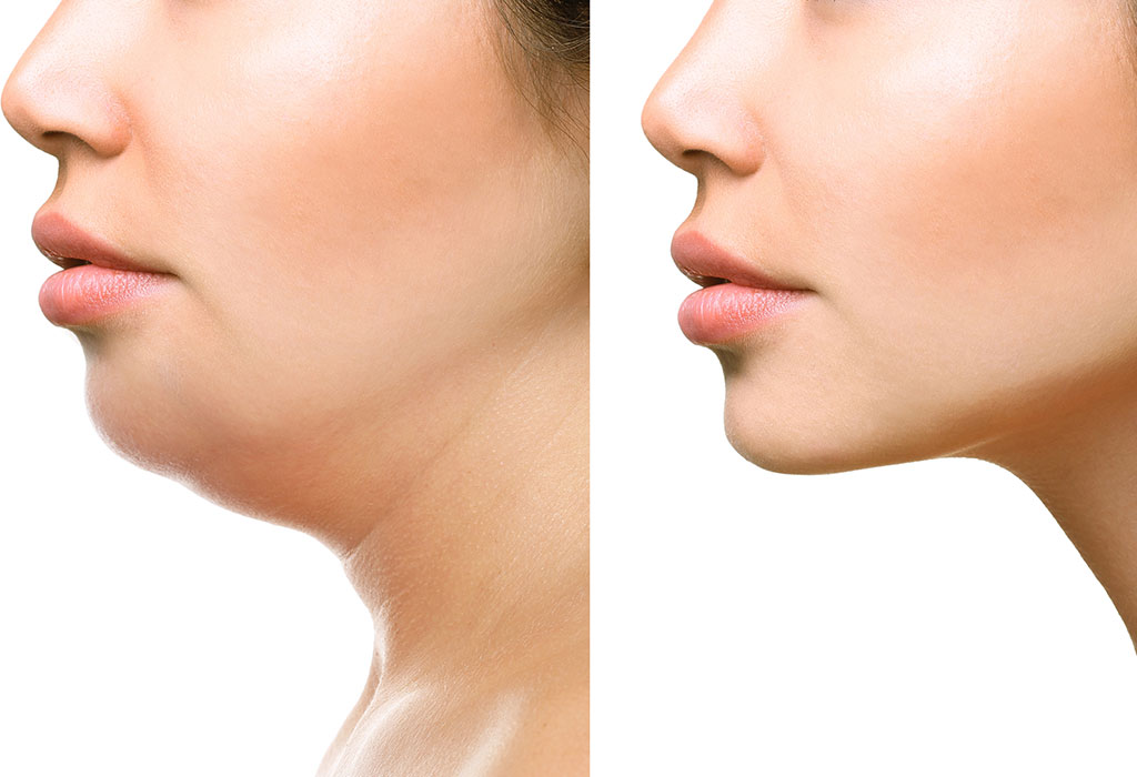 Beyond the Surface: Non-Surgical Double Chin Removal Techniques