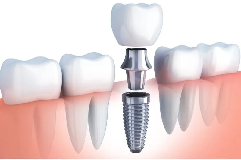 5 Things to Know About Dental Implants